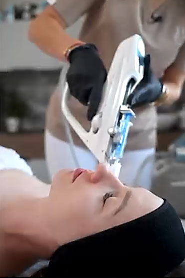 Mezoterapia mikroigłowa próżniowa